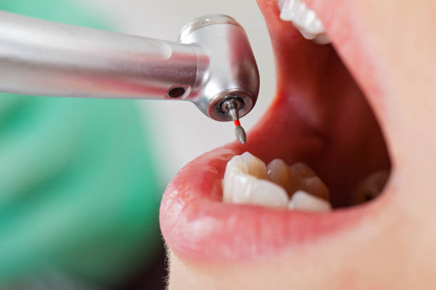 Best Dental Abscess Treatment in Pinehurst, MA